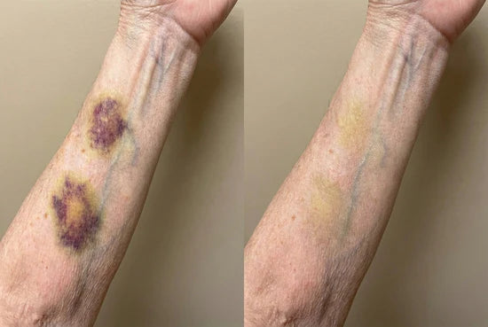 Before and after appearance of bruising on an arm