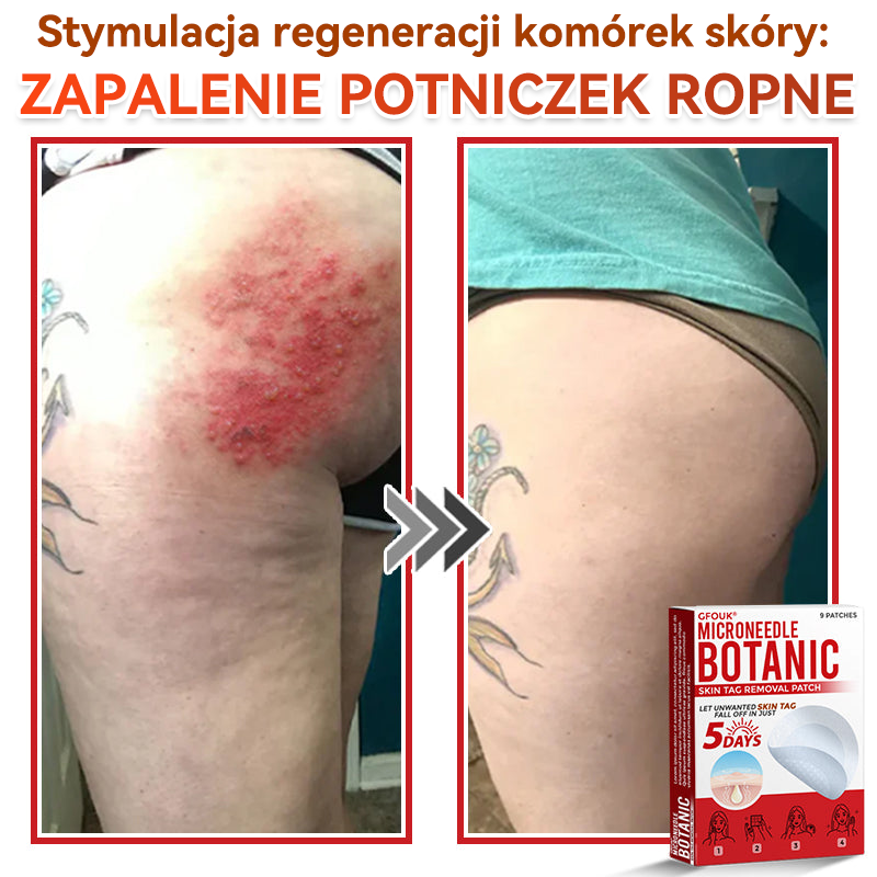 ✅ GFOUK® Plastry do usuwania brodawek i znamion z mikronakłuciami roślinnymi