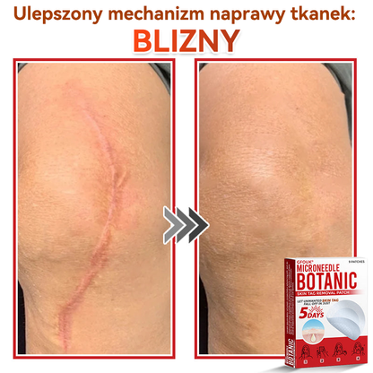 ✅ GFOUK® Plastry do usuwania brodawek i znamion z mikronakłuciami roślinnymi