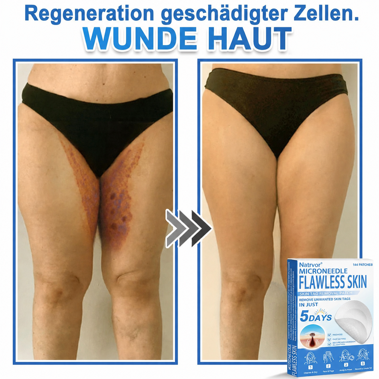 Natrvor® Microdart Hydrogel Patches