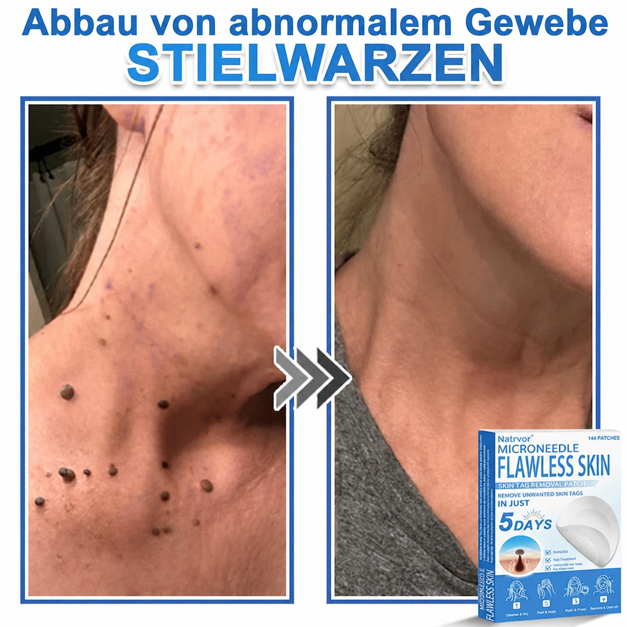 Natrvor® Microdart Hydrogel Patches