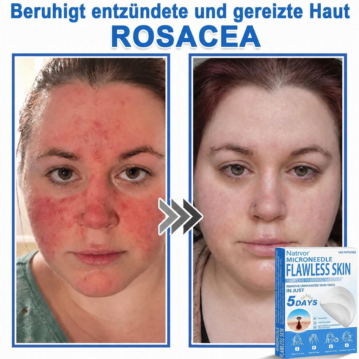 Natrvor® Microdart Hydrogel Patches