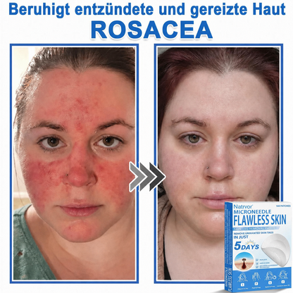 Natrvor® Microdart Hydrogel Patches