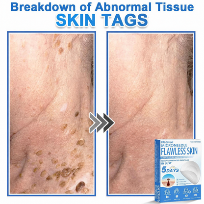 Natrvor® Microdart Hydrogel Patches