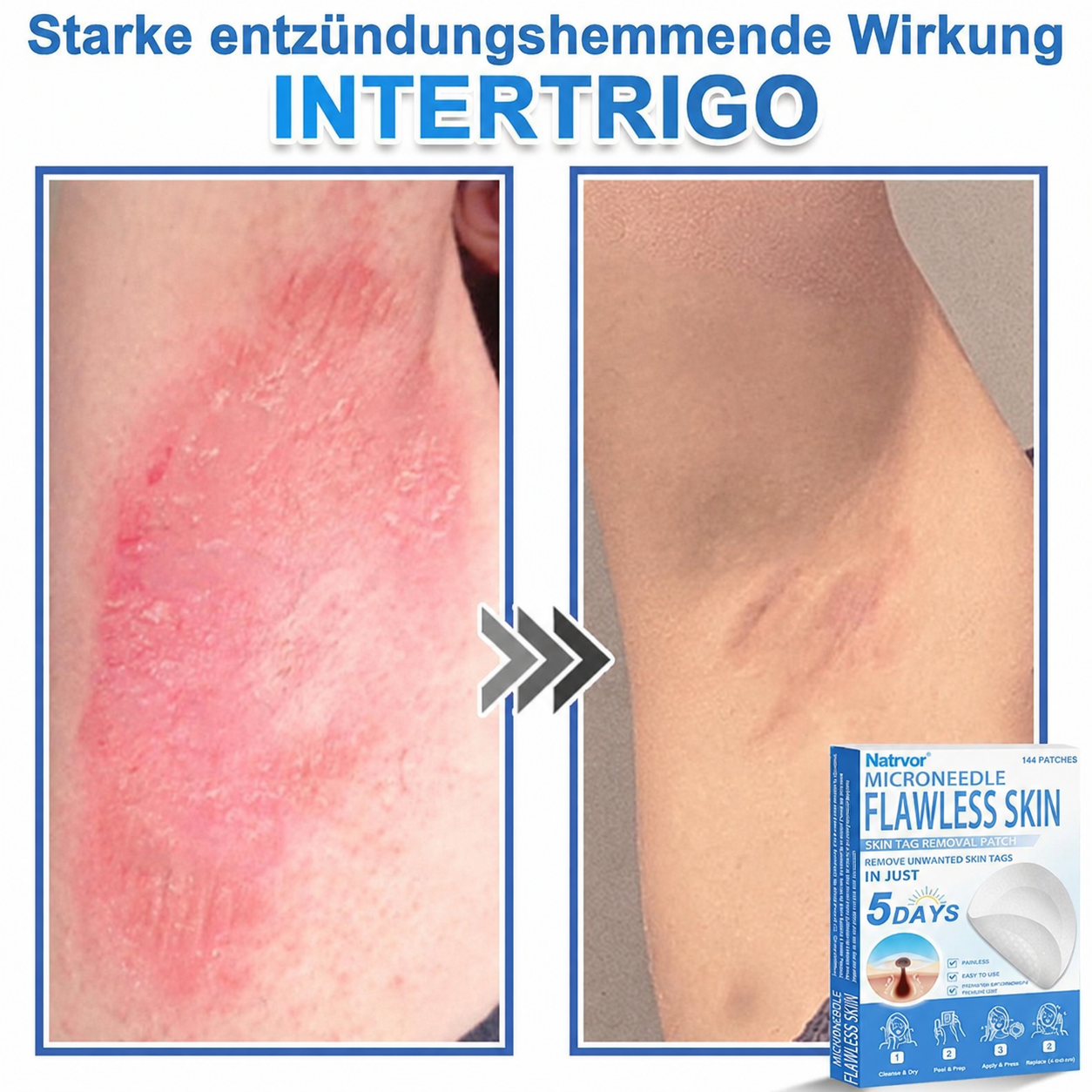 Natrvor® Microdart Hydrogel Patches