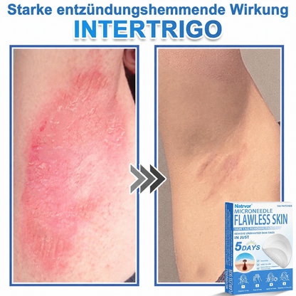 Natrvor® Microdart Hydrogel Patches