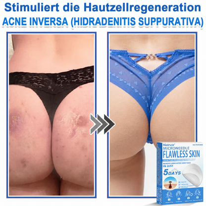 Natrvor® Microdart Hydrogel Patches