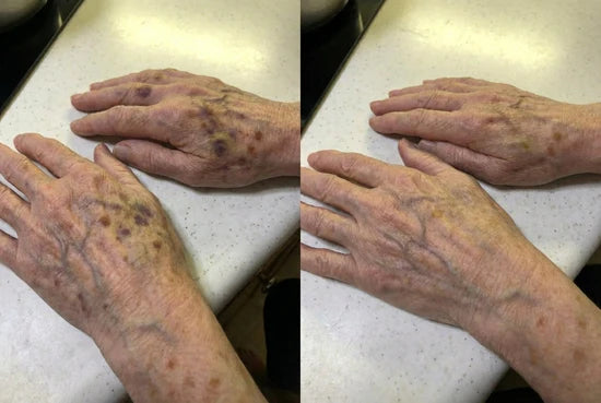 Before and after appearance of marks on hands