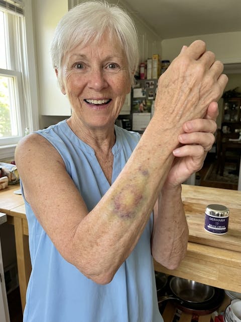 Sarah showing her forearm