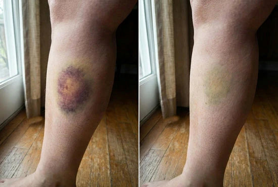 Before and after appearance of a leg bruise