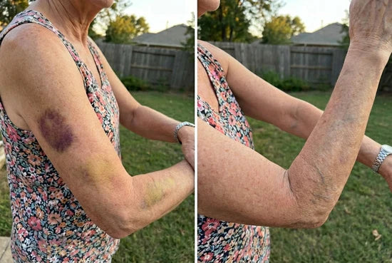 Before and after appearance of bruising on an upper arm