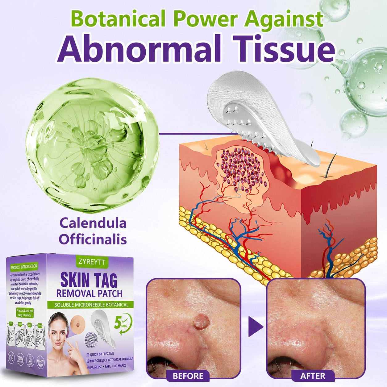ZYREYTT® Soluble Microneedle Botanical Skin Tag Removal Patch