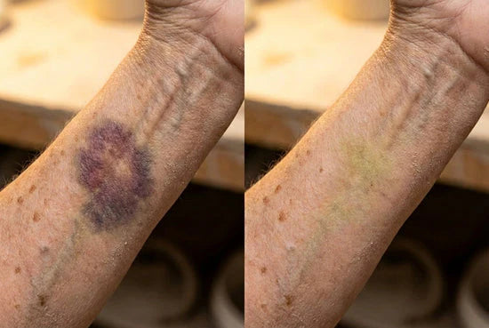 Before and after appearance of bruising on a wrist