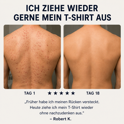 Zanari Rückenseife gegen Akne