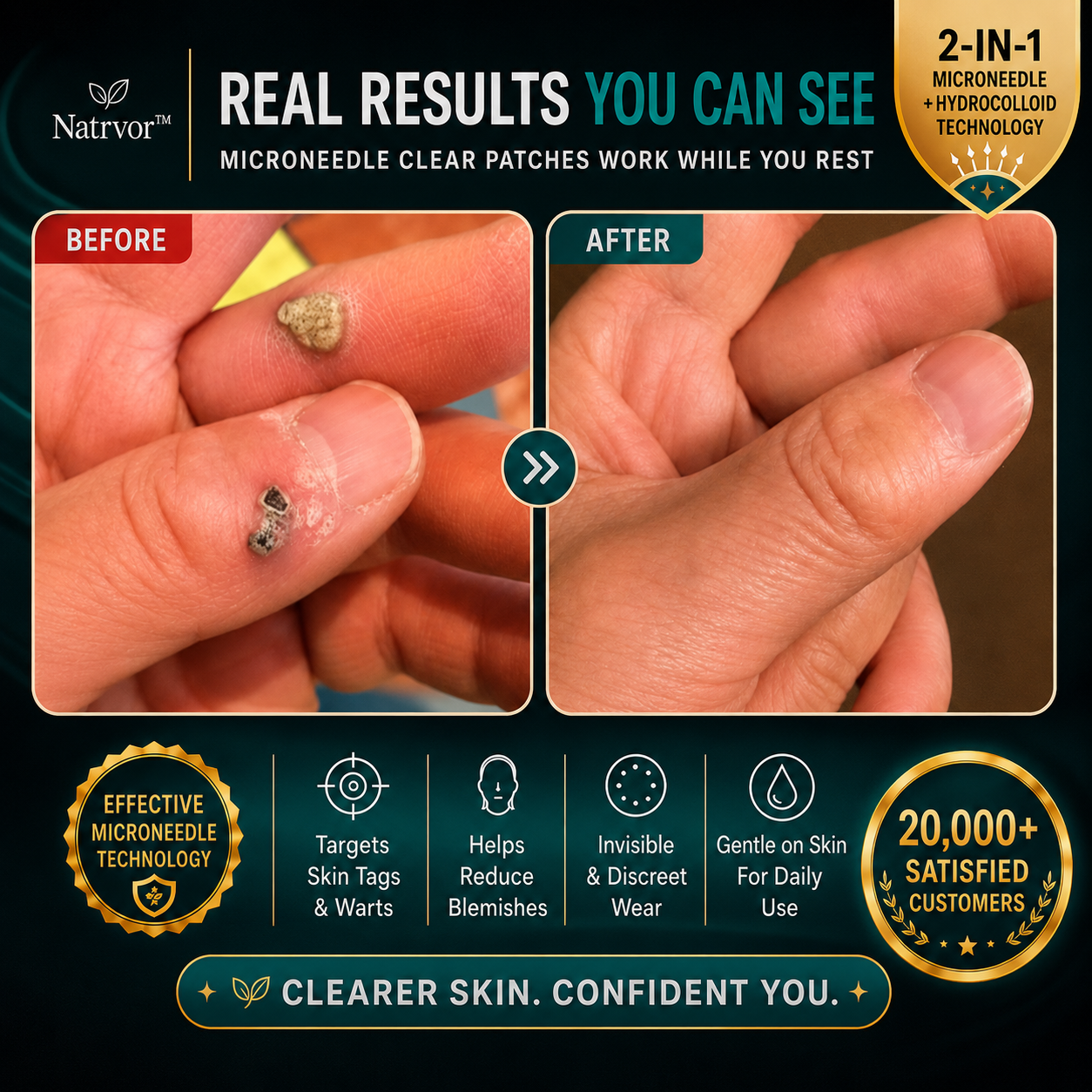 ✨Tenviro®2-in-1 Microneedle & Hydrocolloid Patch🍀| Removes Raised Moles, Acne, Flat Warts & Skin Tags | Helps Improve Wrinkles, Scars & Blemishes | Invisible Patches for Face & Body