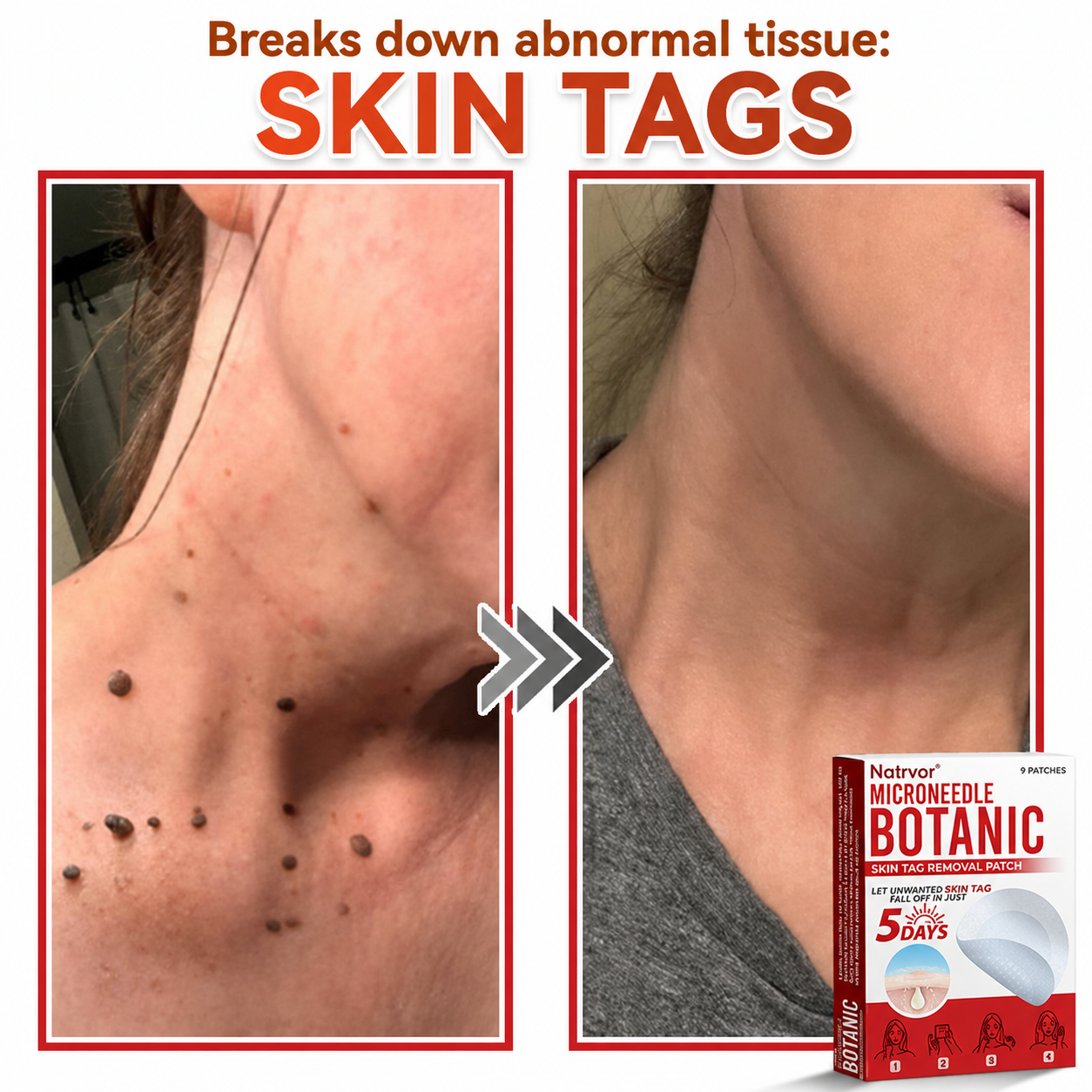 ✅Natrvor® Patches for removing warts and moles using plant-based micro-needles