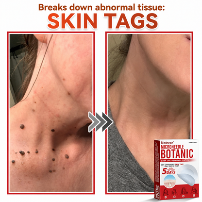 ✅Natrvor® Patches for removing warts and moles using plant-based micro-needles