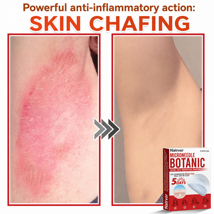 ✅Natrvor® Patches for removing warts and moles using plant-based micro-needles