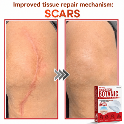 ✅Natrvor® Patches for removing warts and moles using plant-based micro-needles