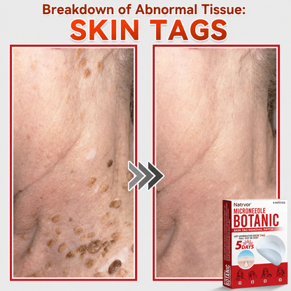✅Natrvor® Patches for removing warts and moles using plant-based micro-needles