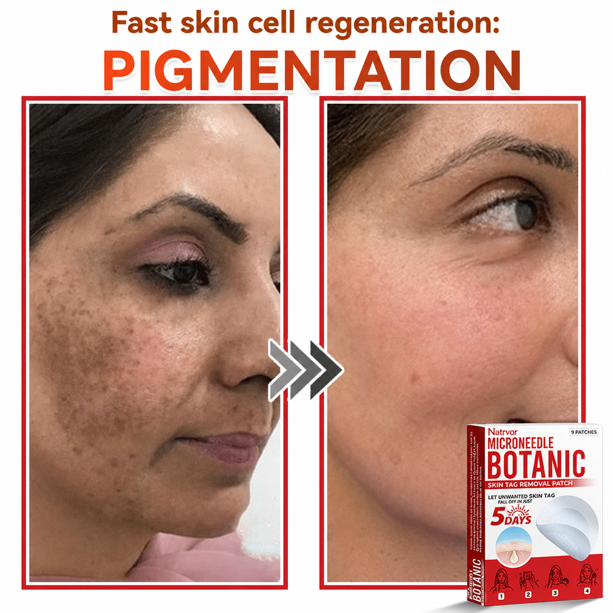 ✅Natrvor® Patches for removing warts and moles using plant-based micro-needles