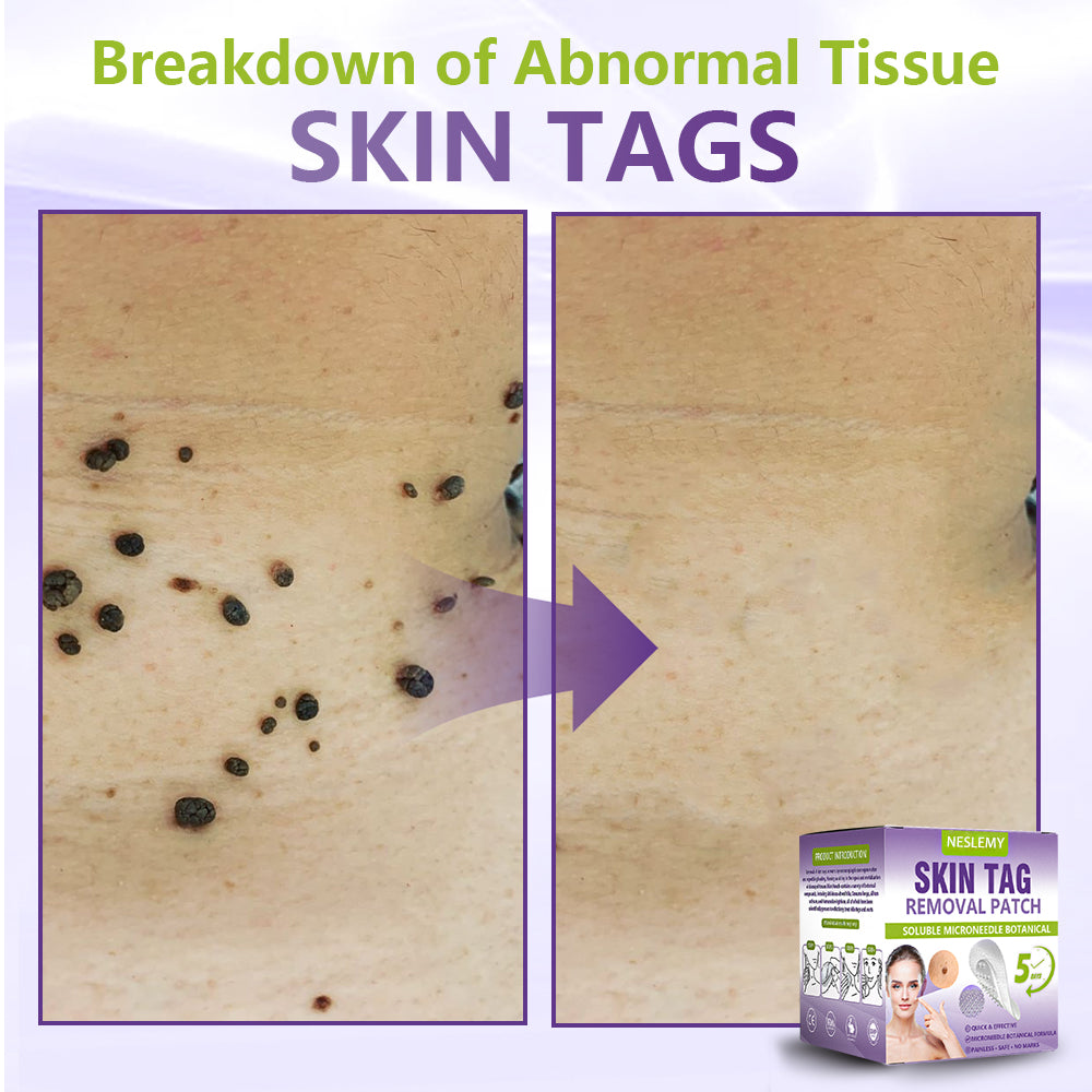 ZYREYTT® Soluble Microneedle Botanical Skin Tag Removal Patch