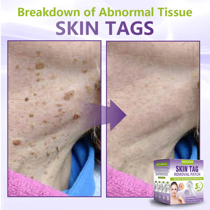ZYREYTT® Soluble Microneedle Botanical Skin Tag Removal Patch