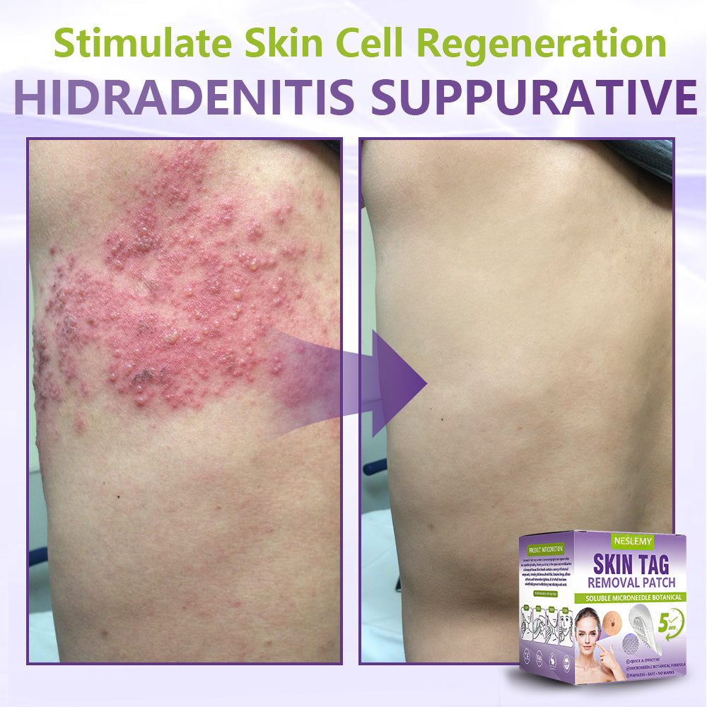 ZYREYTT® Soluble Microneedle Botanical Skin Tag Removal Patch