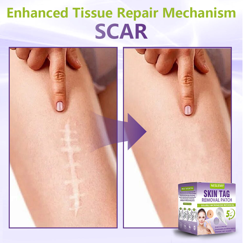 ZYREYTT® Soluble Microneedle Botanical Skin Tag Removal Patch
