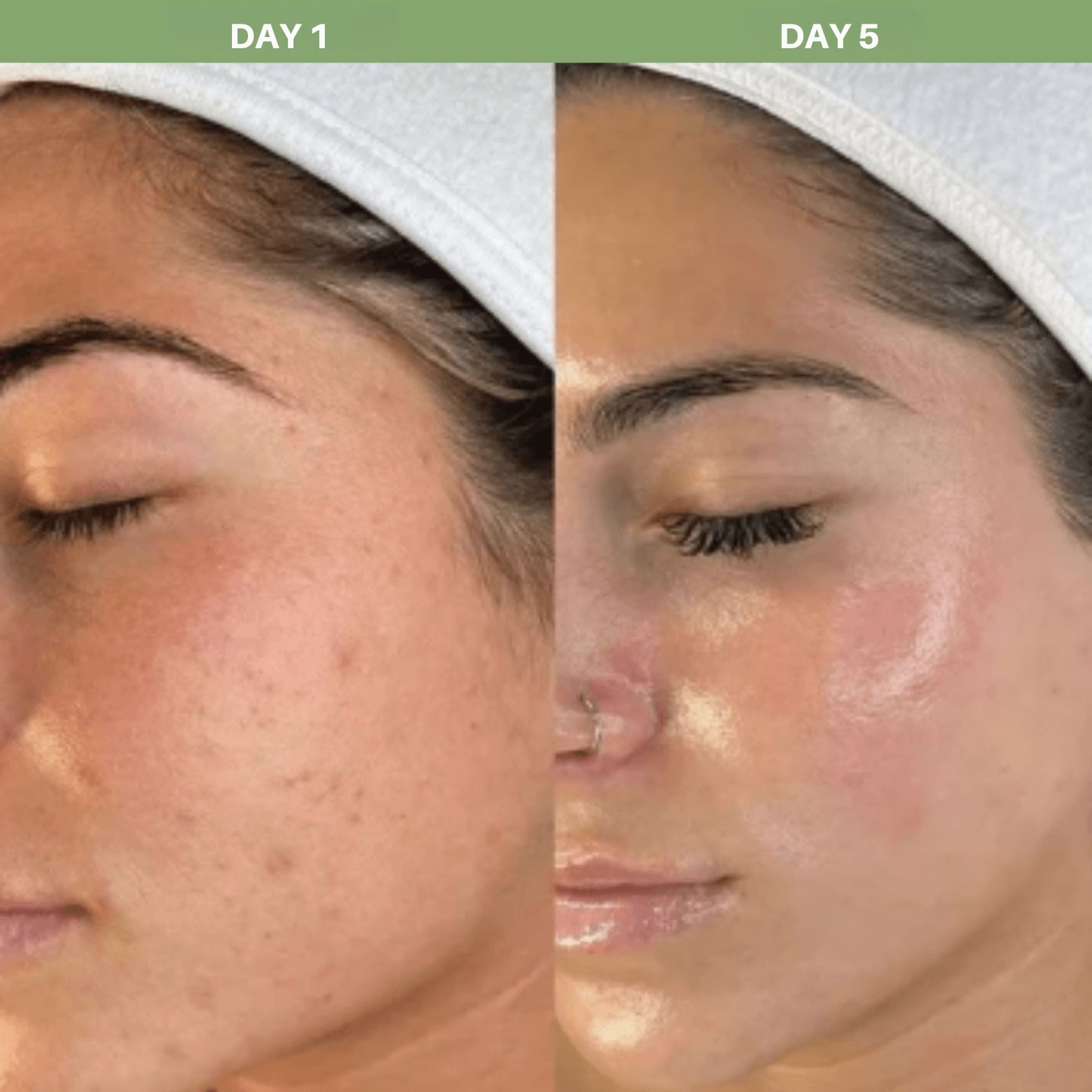 Skin brightening results after using Olivine Beauty Peel Shot rice peeling ampoule